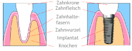 implantant 2